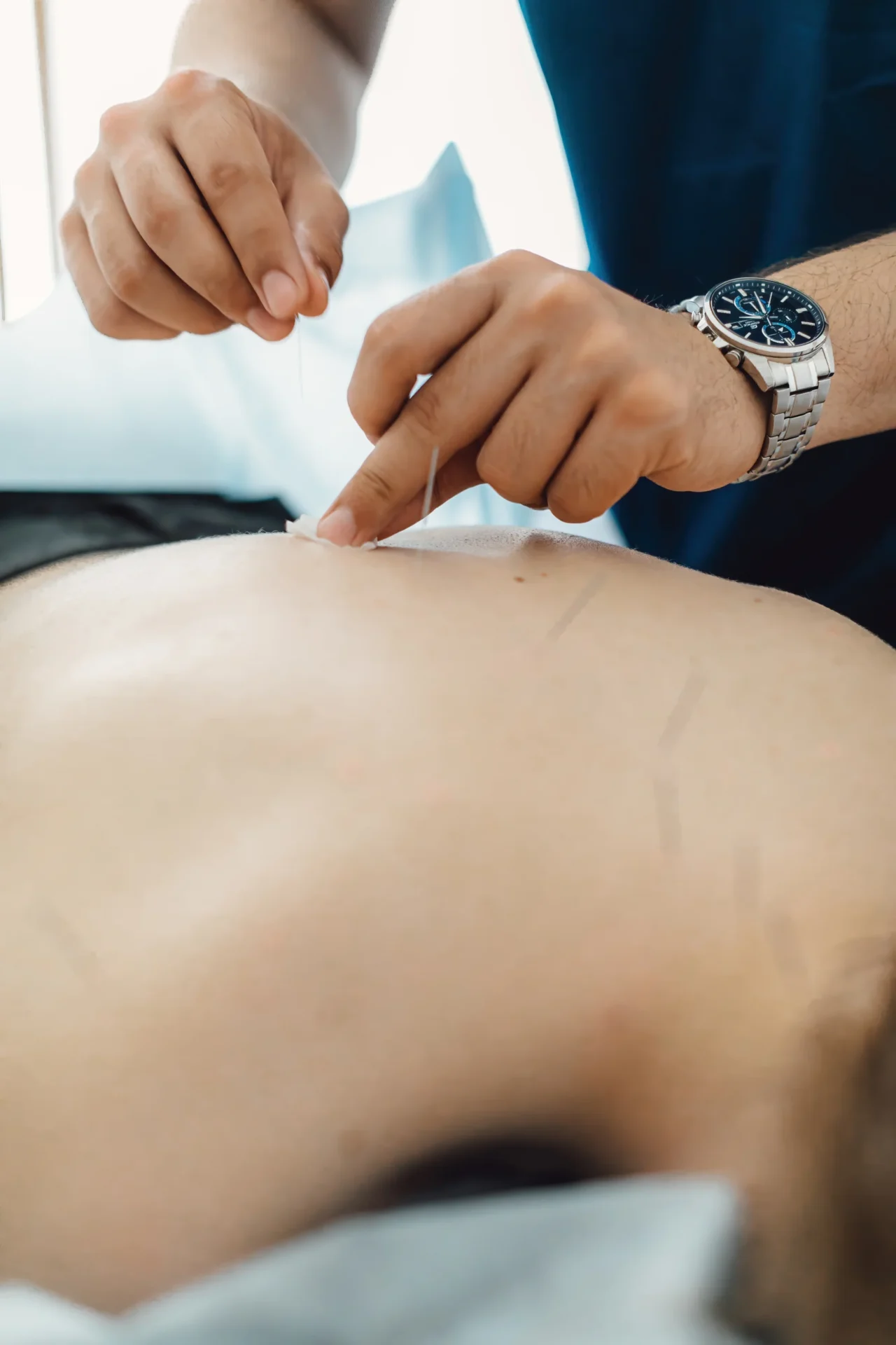 Acupuncture