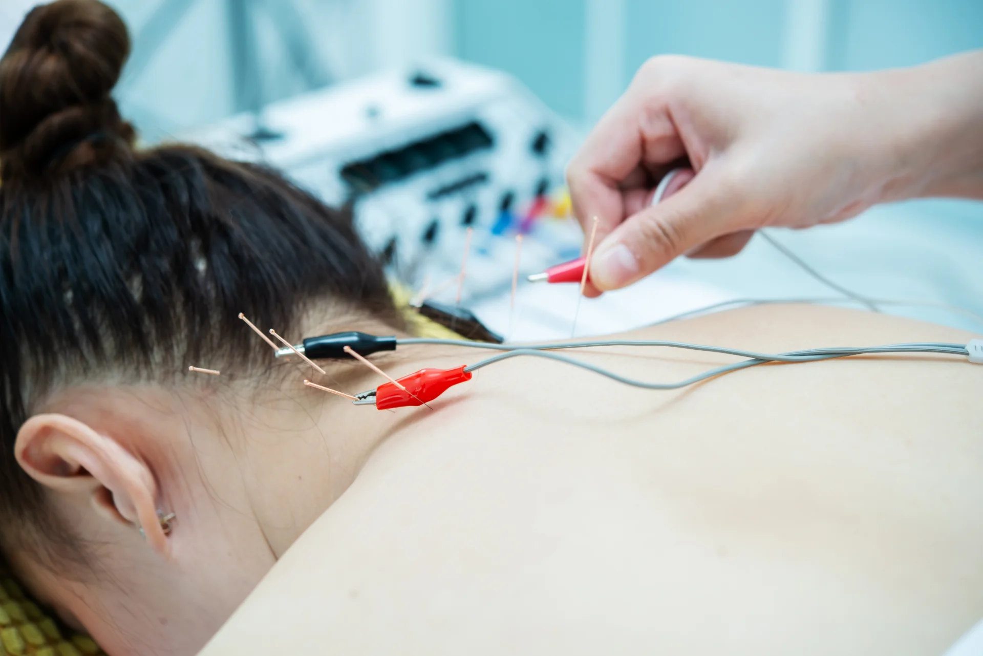 Electroacupuncture