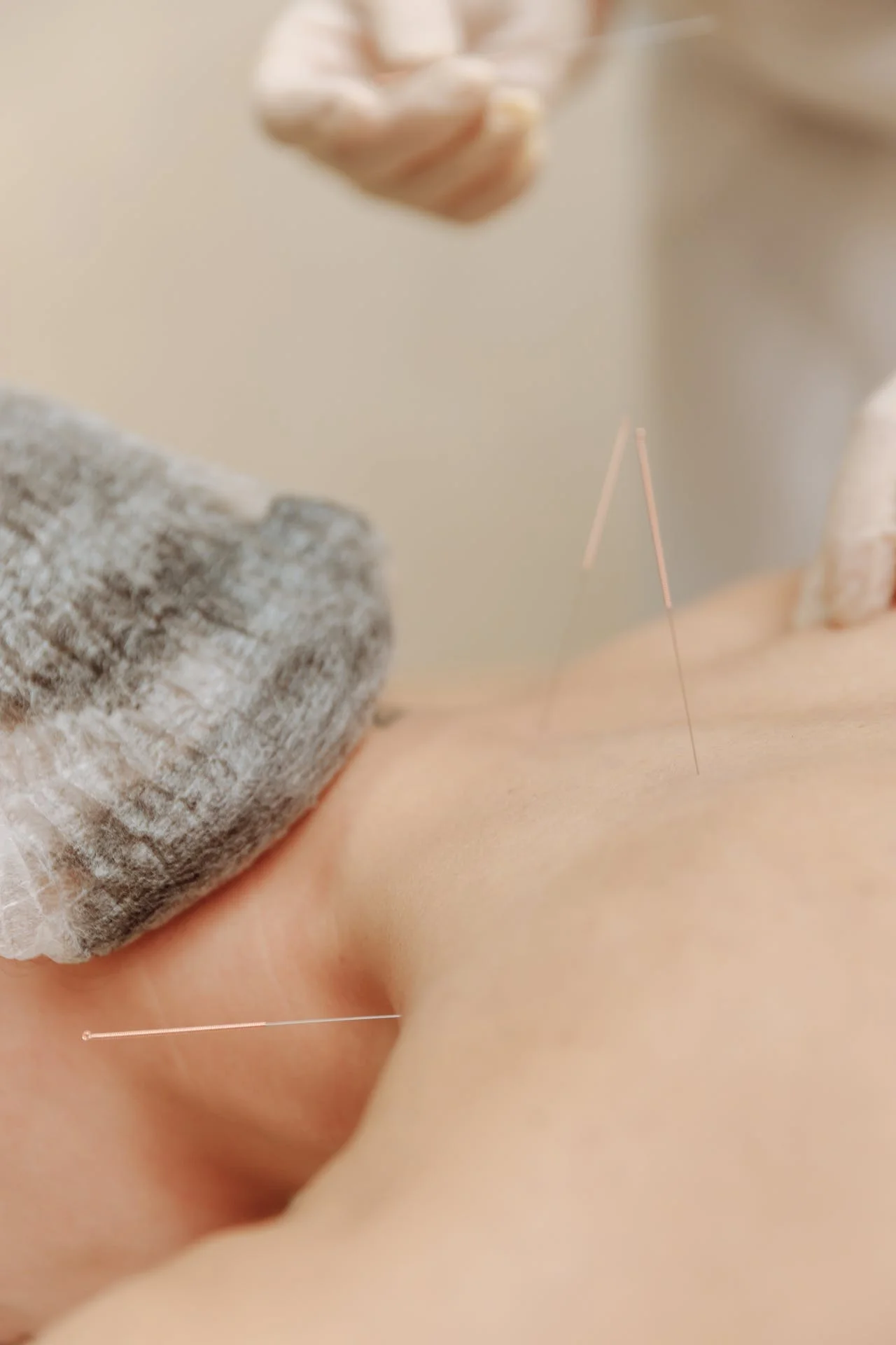 Traditional Chinese Acupuncture
